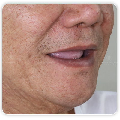 tooth loss