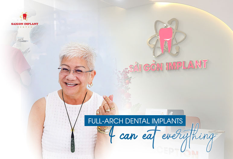 full arch dental implants