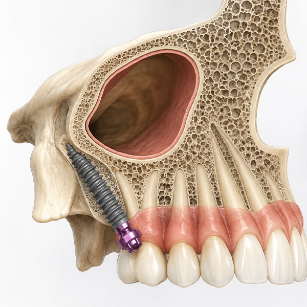 Pterygoid Implants