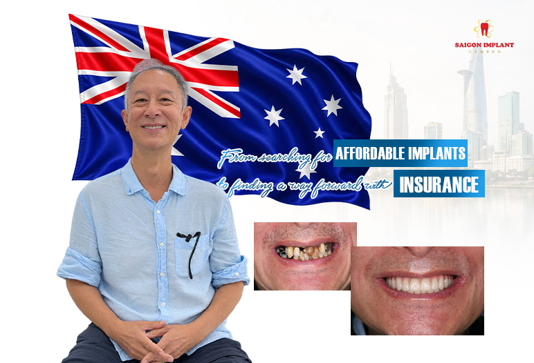 all on 6 implants review