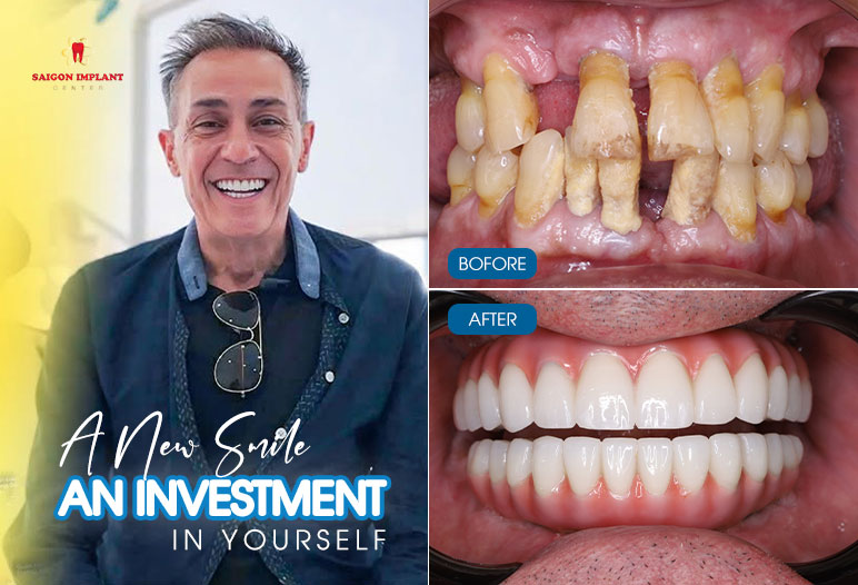 dental implant are worth it