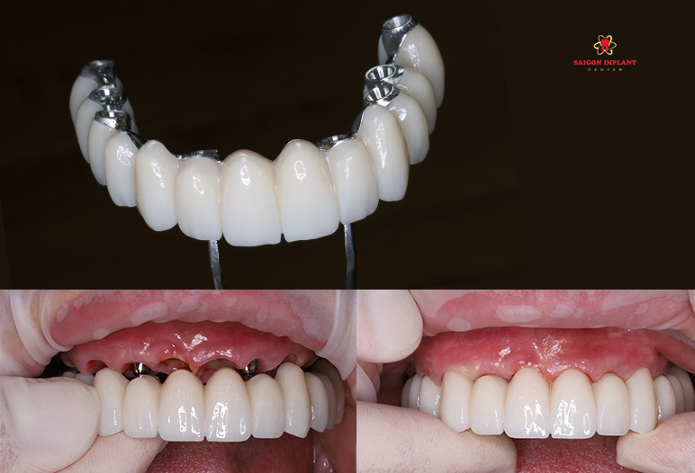 fp1 dental implant restoration