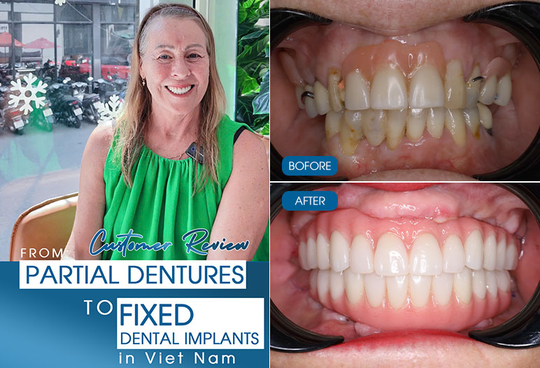 full-arch dental implant in ho chi minh city