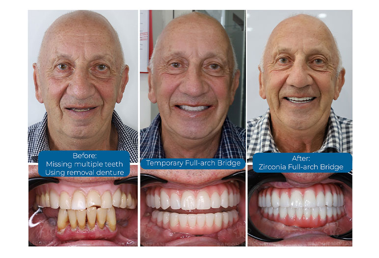 all on six implants