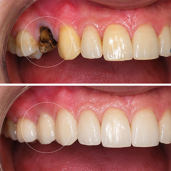 immediate dental implant