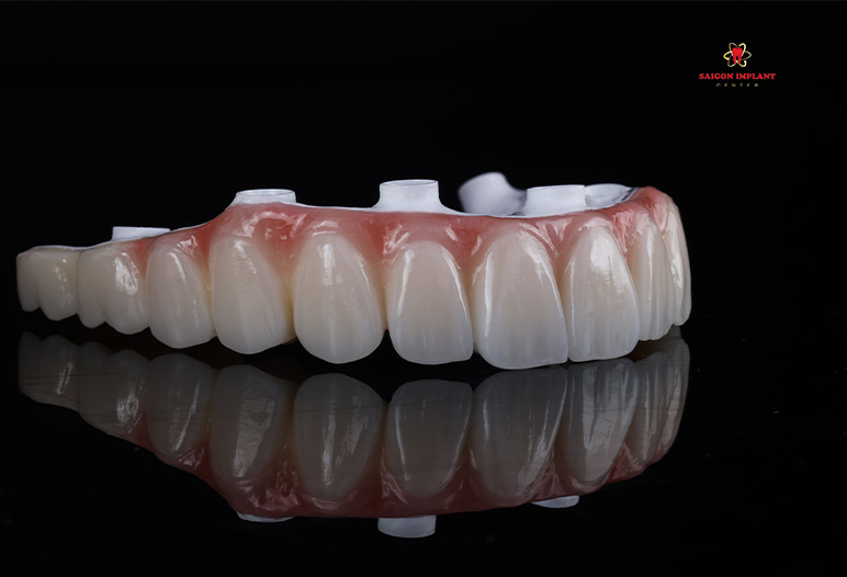 fp2 dental restoration