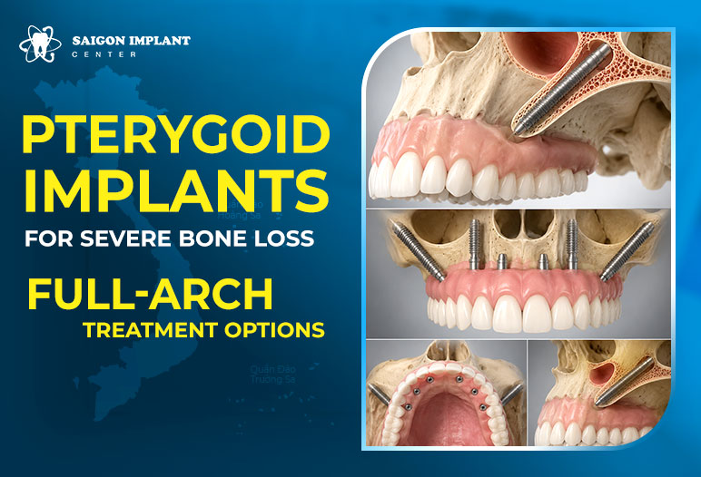 Pterygoid Implants for Severe Bone Loss