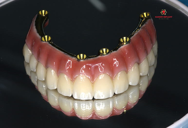fp3 dental restoration
