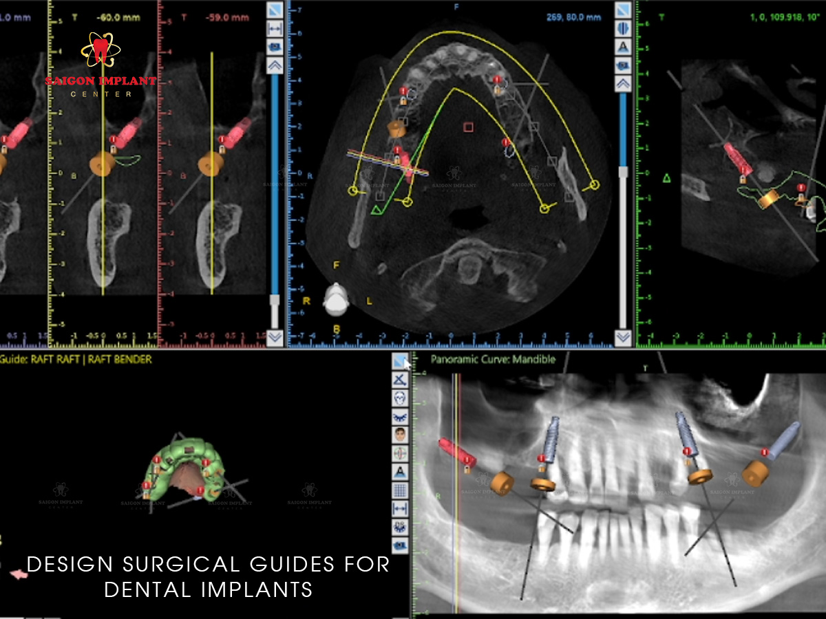 Surgical Guide For Dental Implant surgical guide implant