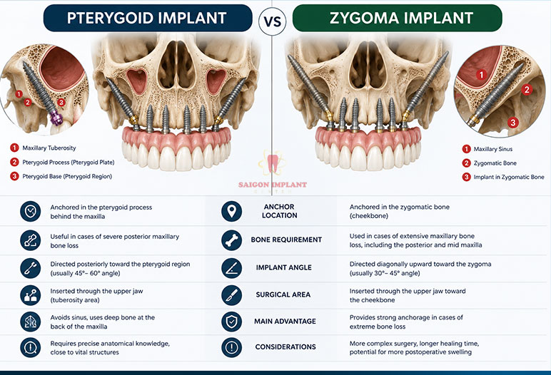 Terygoid Implants Vs Zygoma Implant terygoid implants vs zygoma implant