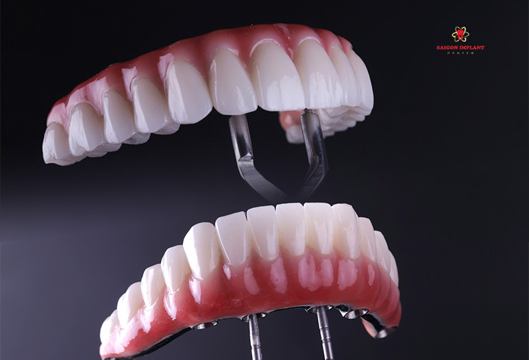 fp2 dental restoration